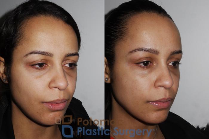 Before & After Skin Care Case 194 Right Oblique View in Washington, DC