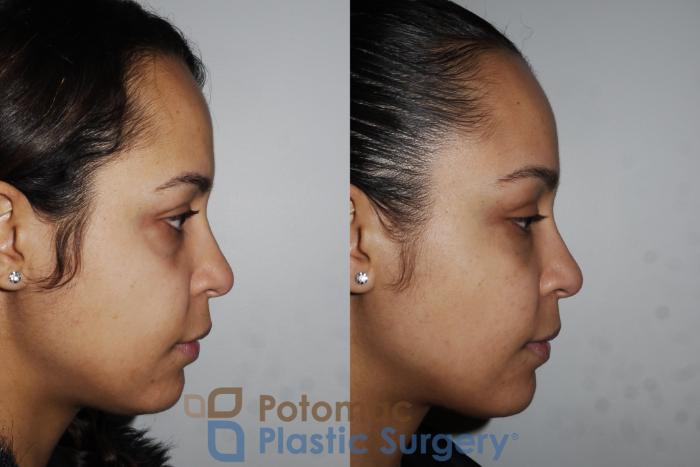 Before & After Skin Care Case 194 Right Side View in Washington, DC