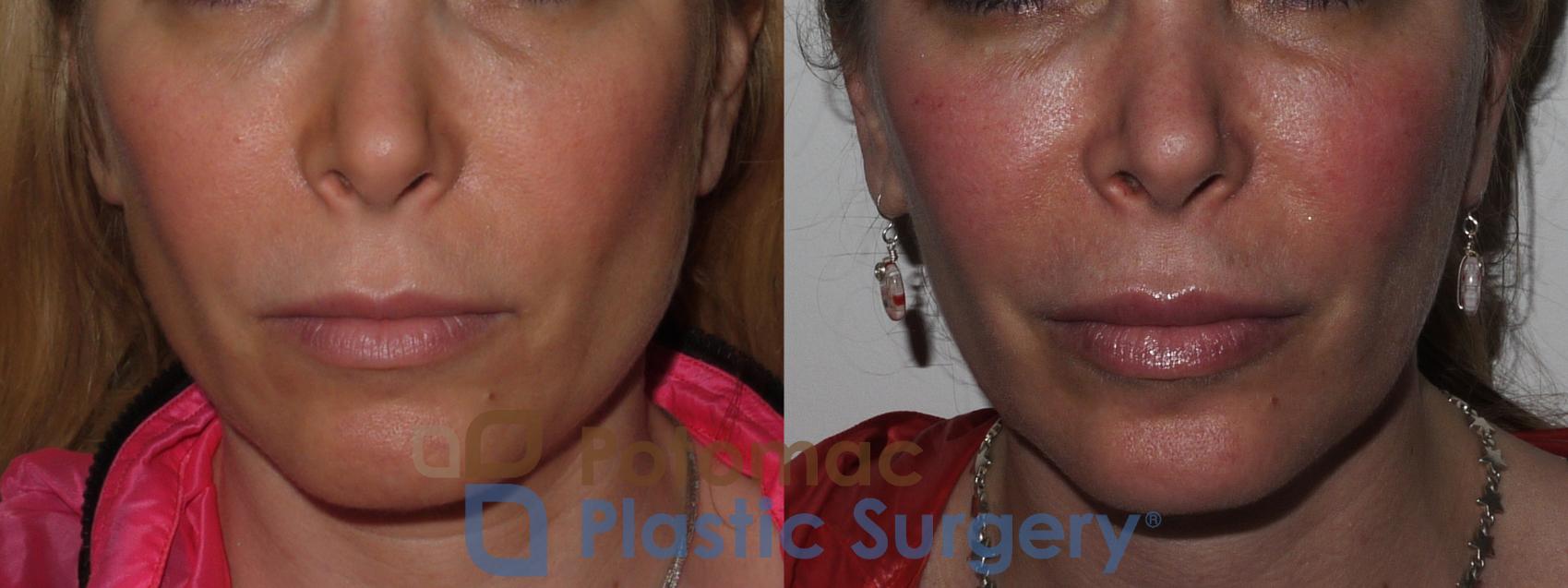 Before & After Botox Cosmetic Case 197 Front Close-Up View #1 View in Washington DC & Arlington , DC