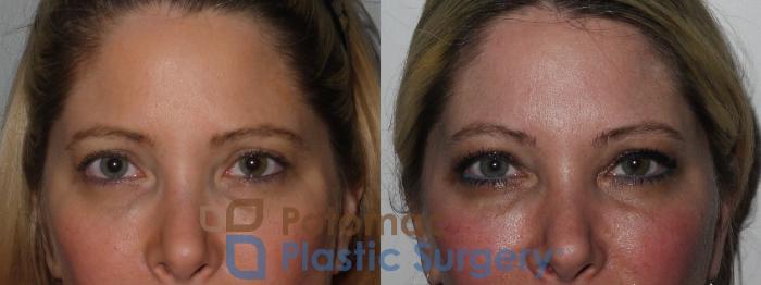 Before & After Lip Augmentation Case 197 Front Close-Up View #2 View in Washington DC & Arlington , DC