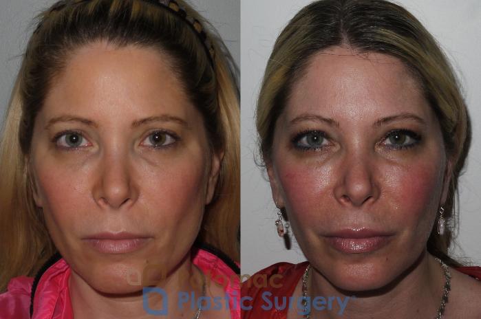 Before & After Cheek Augmentation Case 197 Front View #1 View in Washington DC & Arlington , DC