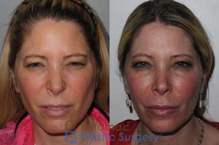 Before & After Cheek Augmentation Case 197 Front View #2 View in Washington DC & Arlington , DC