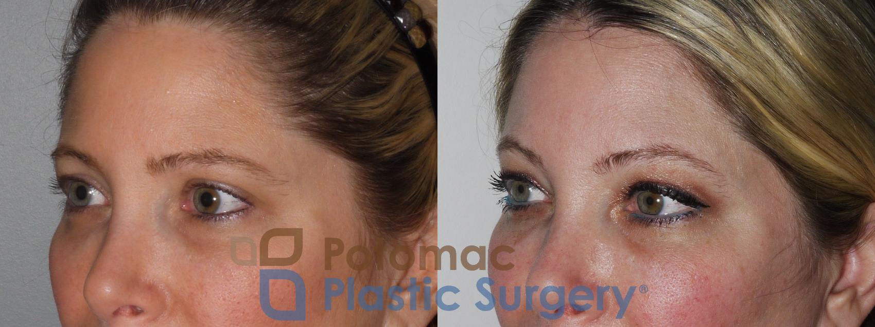 Before & After Botox Cosmetic Case 197 Left Oblique Close-Up View in Washington DC & Arlington , DC