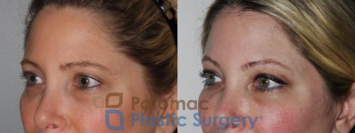 Before & After Botox Cosmetic Case 197 Left Oblique Close-Up View in Washington DC & Arlington , DC