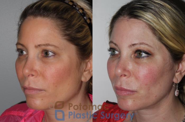 Before & After Botox Cosmetic Case 197 Left Oblique View in Washington DC & Arlington , DC