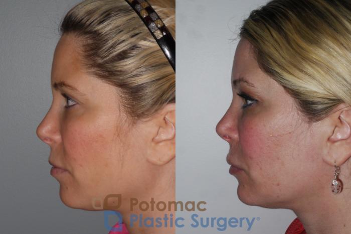 Before & After Facial Sculpting Case 197 Left Side View in Washington DC & Arlington , DC