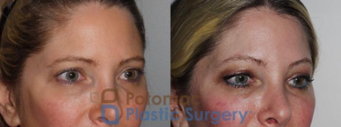Before & After Cheek Augmentation Case 197 Right Oblique Close-Up View in Washington DC & Arlington , DC