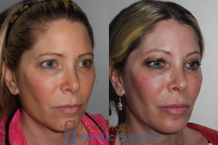 Before & After Lip Augmentation Case 197 Right Oblique View in Washington DC & Arlington , DC