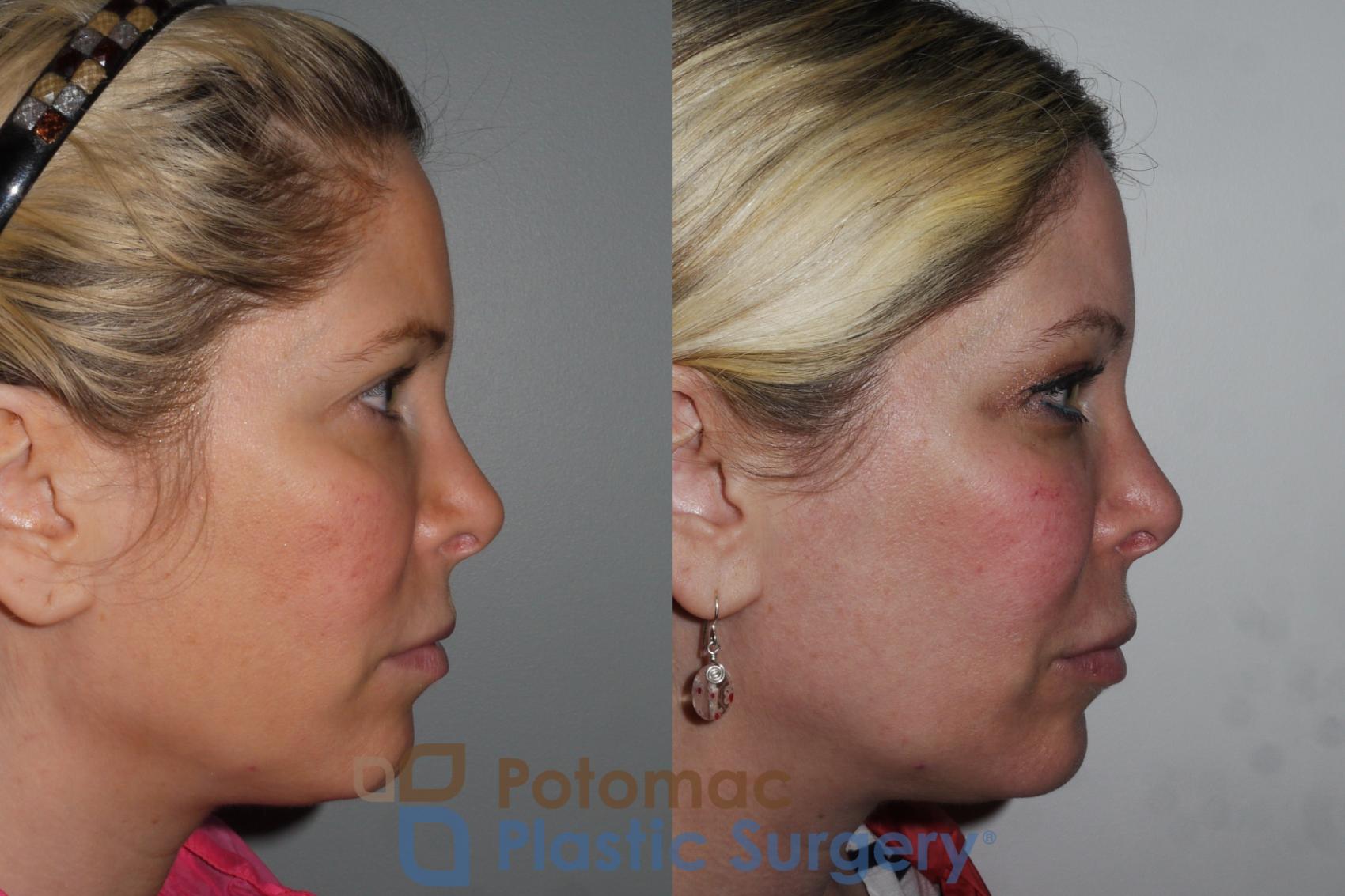 Before & After Botox Cosmetic Case 197 Right Side View in Washington DC & Arlington , DC