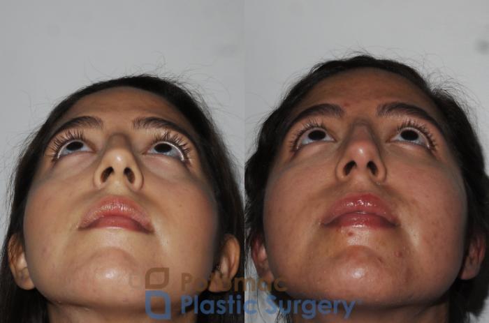 Before & After Liquid Facelift Case 204 Bottom View in Washington DC & Arlington , DC