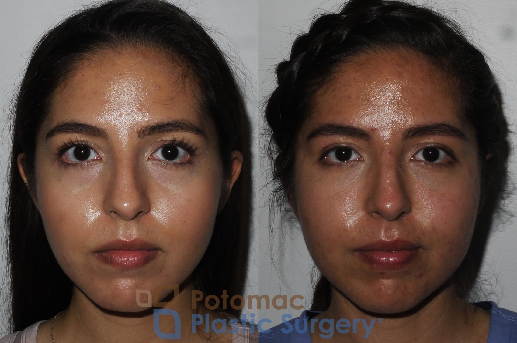 Before & After Liquid Facelift Case 204 Front View in Washington DC & Arlington , DC