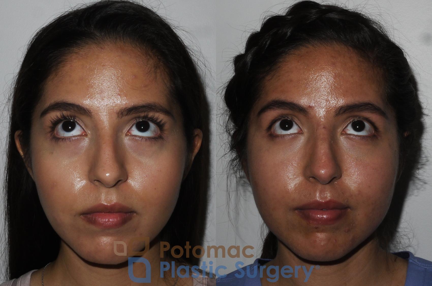 Before & After Liquid Facelift Case 204 Front View #2 View in Washington DC & Arlington , DC