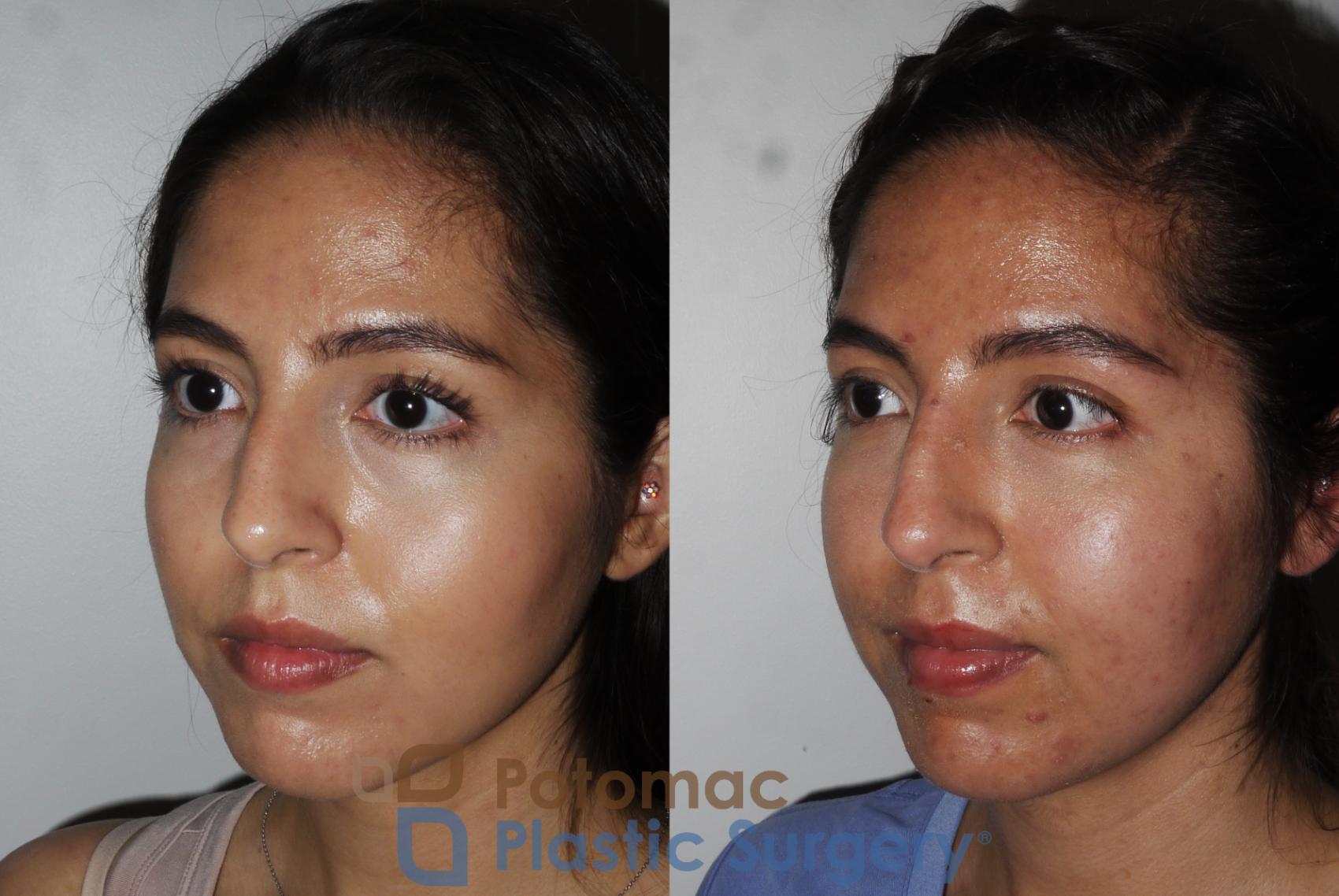 Before & After Liquid Facelift Case 204 Left Oblique View in Washington DC & Arlington , DC