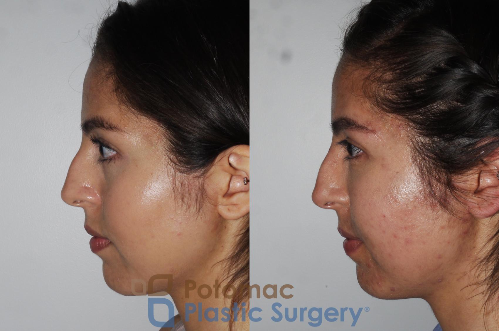 Before & After Liquid Facelift Case 204 Left Side View in Washington DC & Arlington , DC