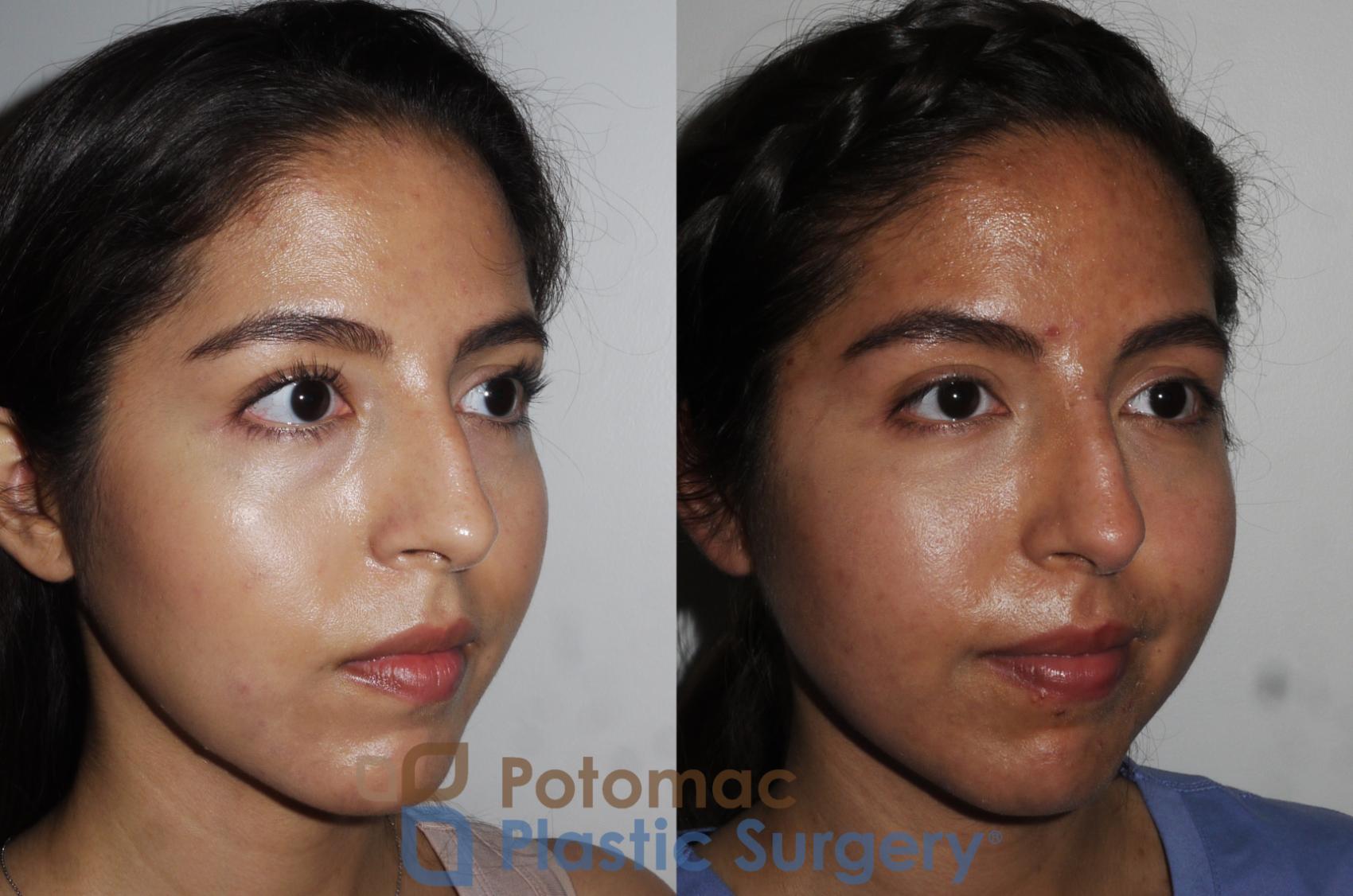 Before & After Liquid Facelift Case 204 Right Oblique View in Washington DC & Arlington , DC