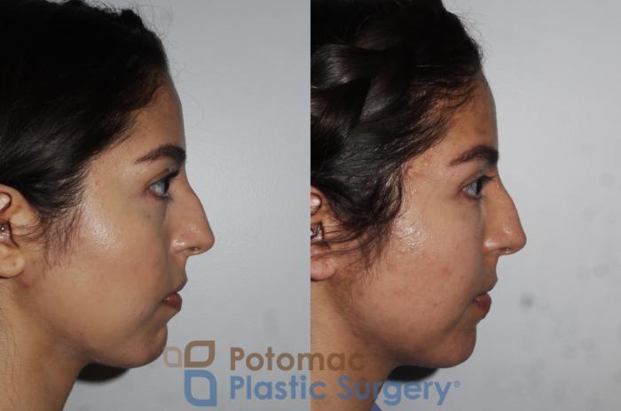 Before & After Liquid Facelift Case 204 Right Side View in Washington DC & Arlington , DC