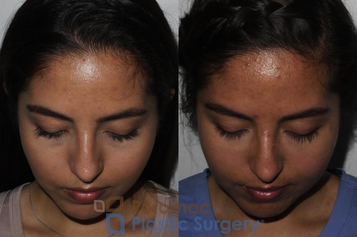 Before & After Liquid Facelift Case 204 Top View in Washington DC & Arlington , DC