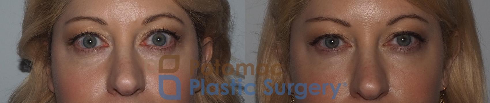 Before & After Botox Cosmetic Case 223 Front Close-Up View #1 View in Washington, DC