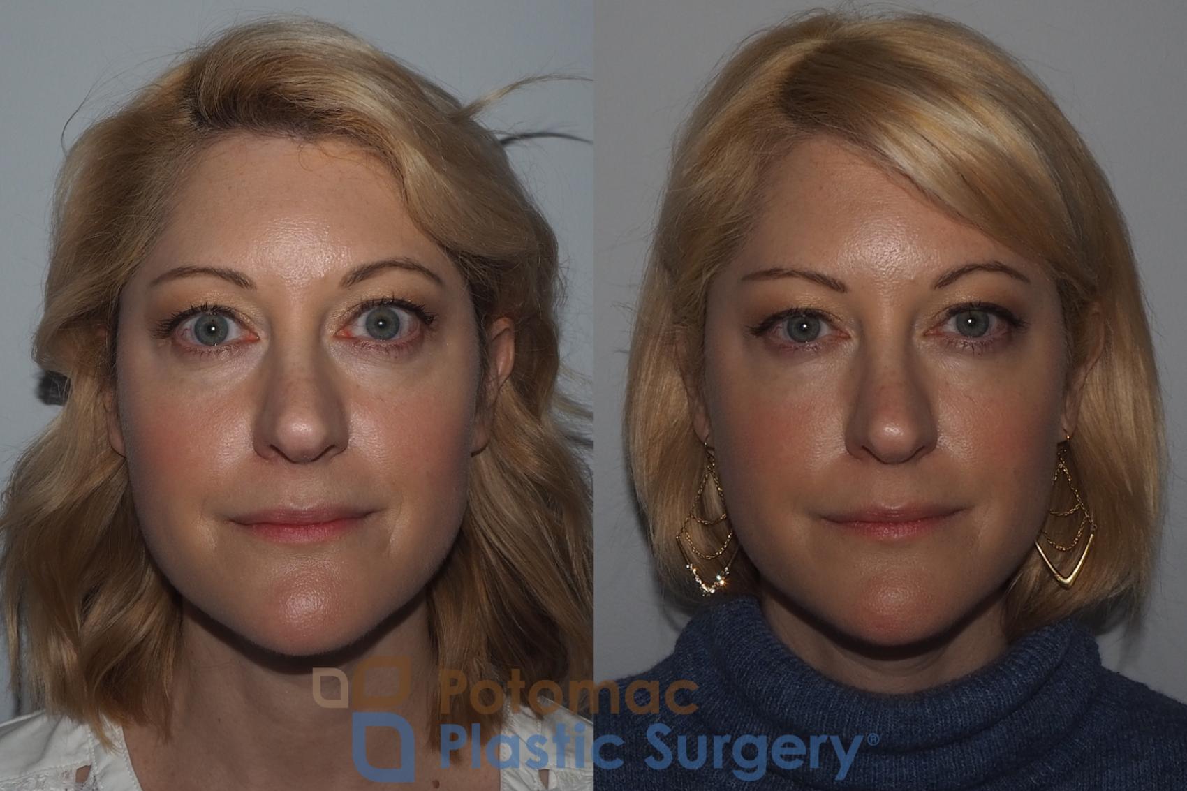 Before & After Botox Cosmetic Case 223 Front View #1 View in Washington, DC