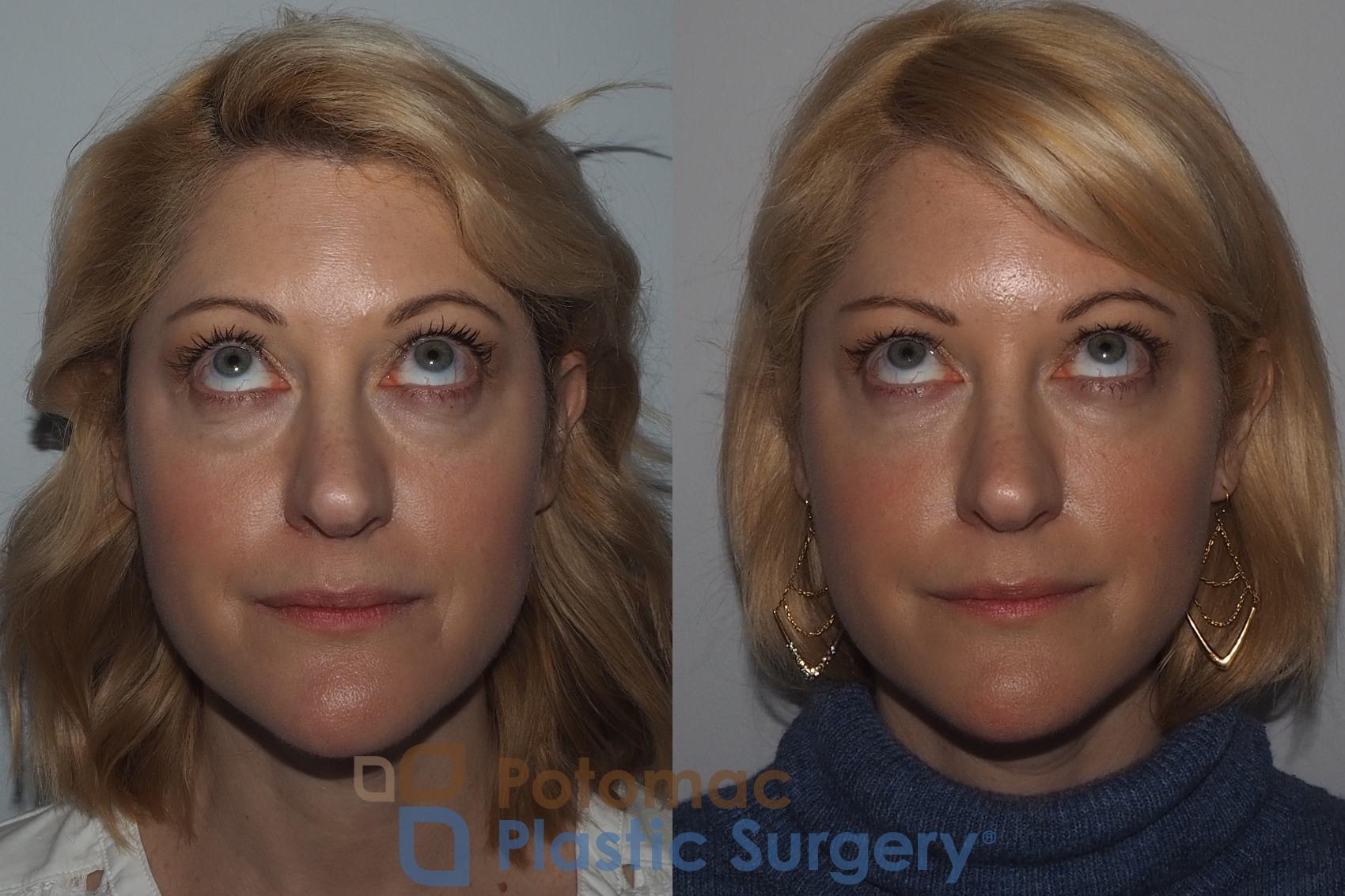 Before & After Botox Cosmetic Case 223 Front View #2 View in Washington, DC