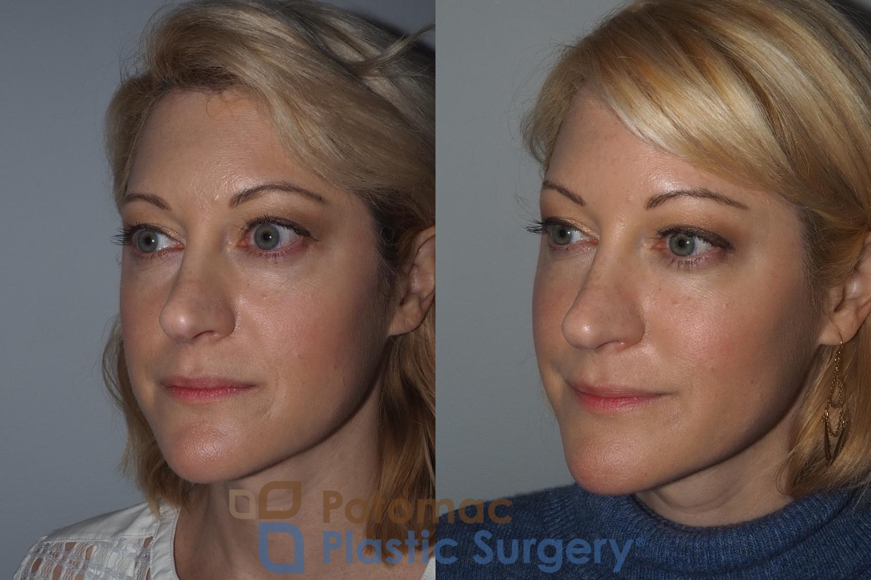 Before & After Botox Cosmetic Case 223 Left Oblique View in Washington, DC