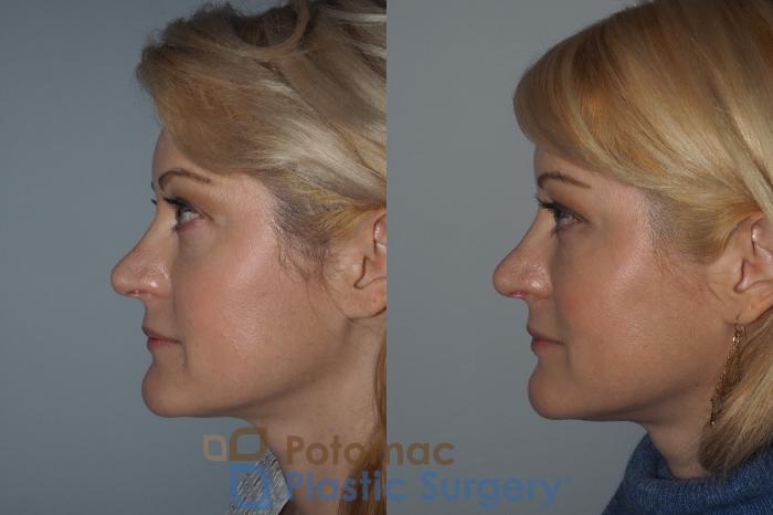 Before & After Liquid Facelift Case 223 Left Side View in Washington, DC