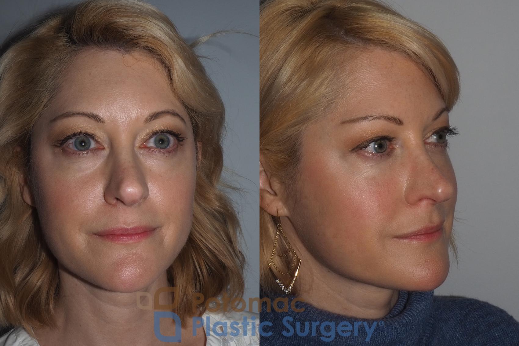 Before & After Botox Cosmetic Case 223 Right Oblique View in Washington, DC