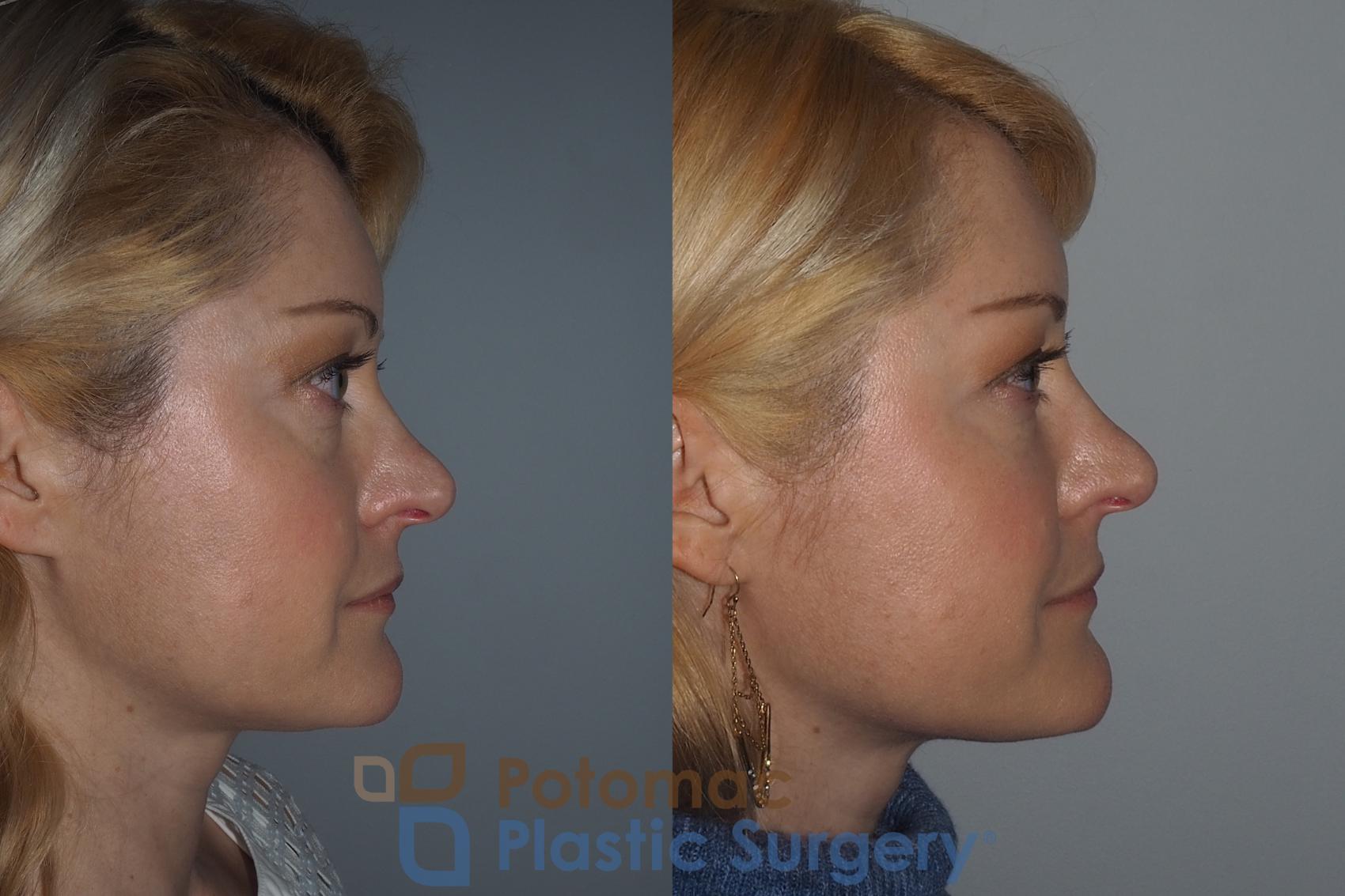 Before & After Botox Cosmetic Case 223 Right Side View in Washington, DC