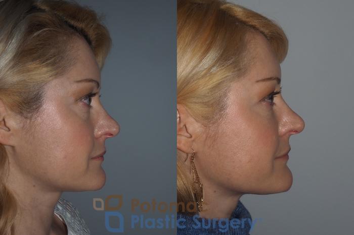 Before & After Liquid Facelift Case 223 Right Side View in Washington, DC