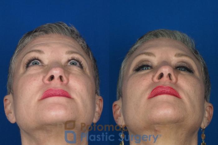 Before & After Liquid Facelift Case 227 Bottom View in Washington DC & Arlington , DC