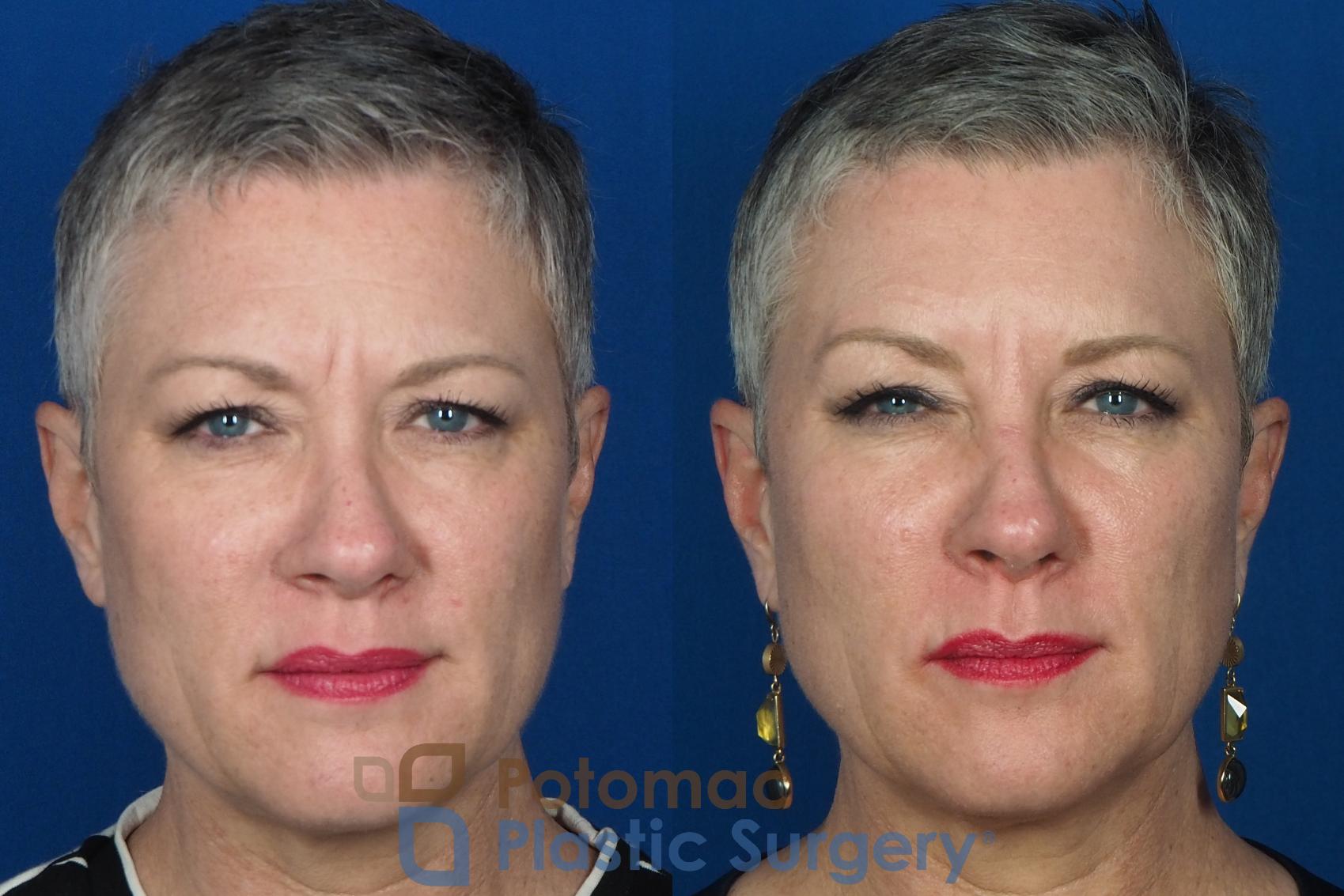 Before & After Liquid Facelift Case 227 Front View #2 View in Washington DC & Arlington , DC