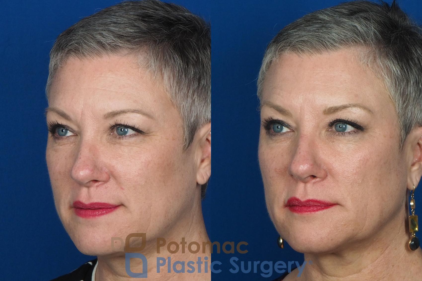 Before & After Liquid Facelift Case 227 Left Oblique View in Washington DC & Arlington , DC