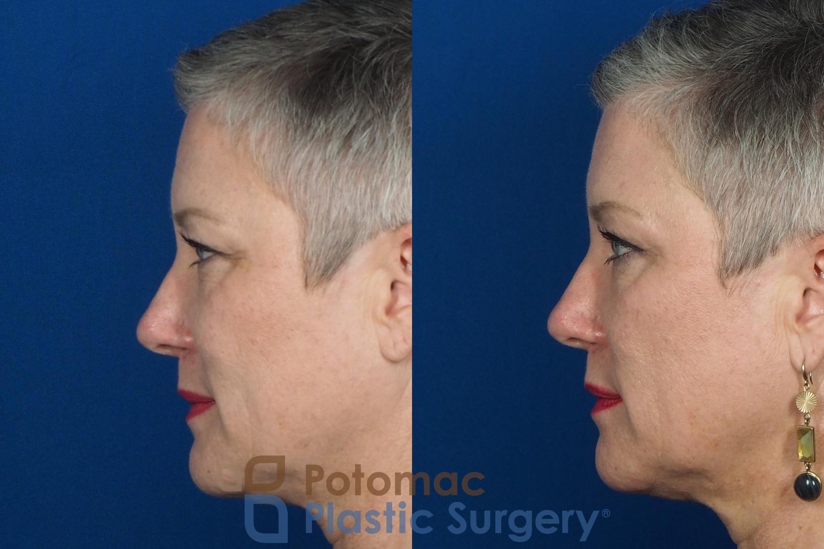 Before & After Liquid Facelift Case 227 Left Side View in Washington DC & Arlington , DC