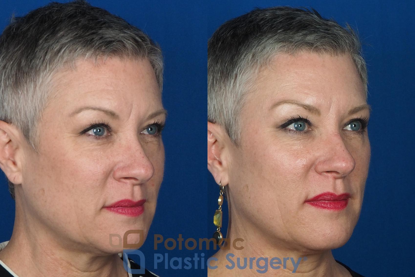 Before & After Liquid Facelift Case 227 Right Oblique View in Washington DC & Arlington , DC