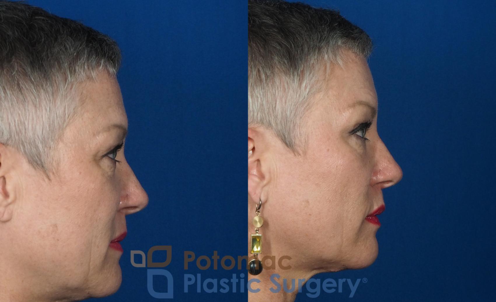 Before & After Liquid Facelift Case 227 Right Side View in Washington DC & Arlington , DC