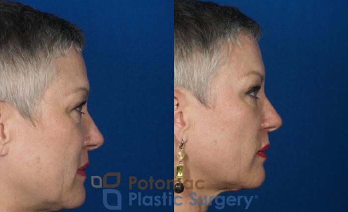 Before & After Liquid Facelift Case 227 Right Side View in Washington DC & Arlington , DC