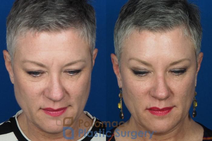 Before & After Liquid Facelift Case 227 Top View in Washington DC & Arlington , DC