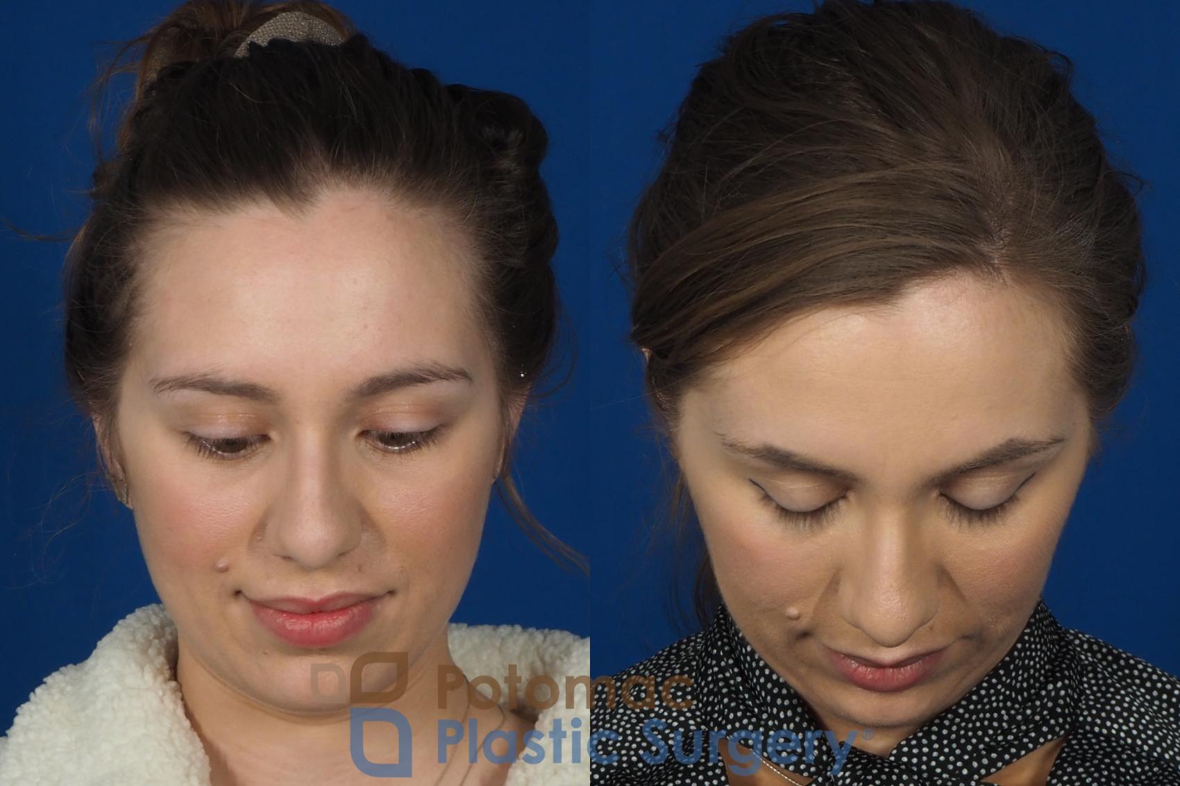 Before & After Dermal Fillers Case 242 Above View in Washington DC & Arlington , DC