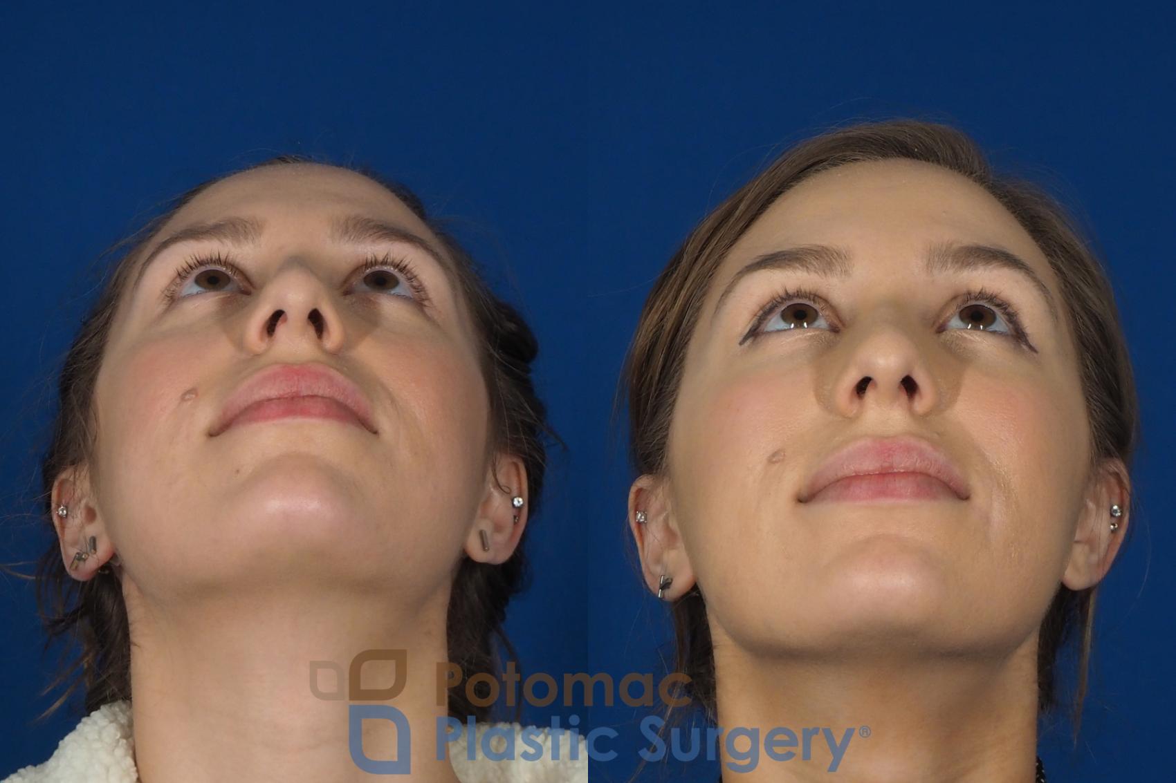 Before & After Dermal Fillers Case 242 Below View in Washington DC & Arlington , DC