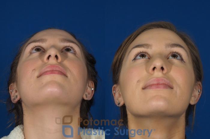 Before & After Botox Cosmetic Case 242 Below View in Washington DC & Arlington , DC