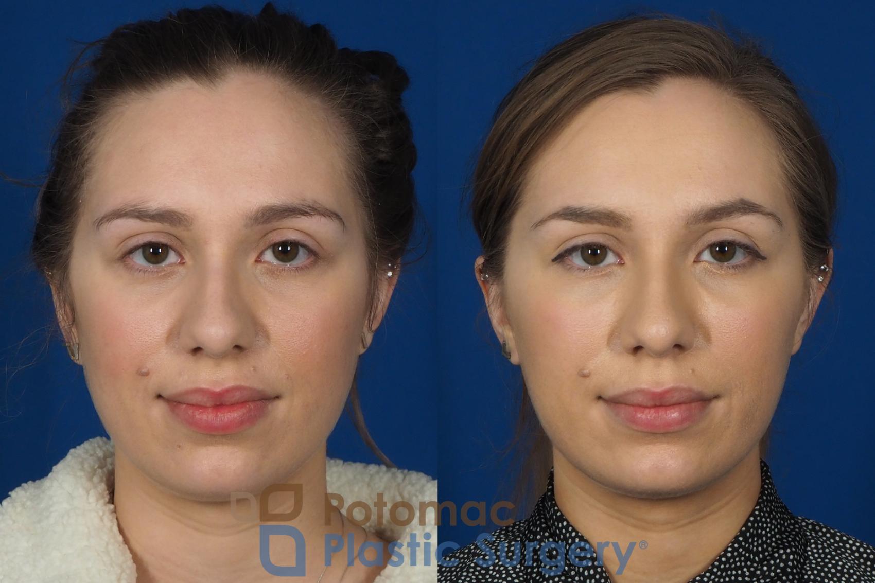 Before & After Botox Cosmetic Case 242 Front View #1 View in Washington DC & Arlington , DC
