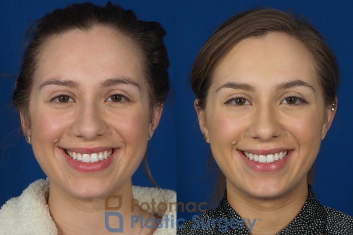 Before & After Botox Cosmetic Case 242 Front View #2 View in Washington DC & Arlington , DC