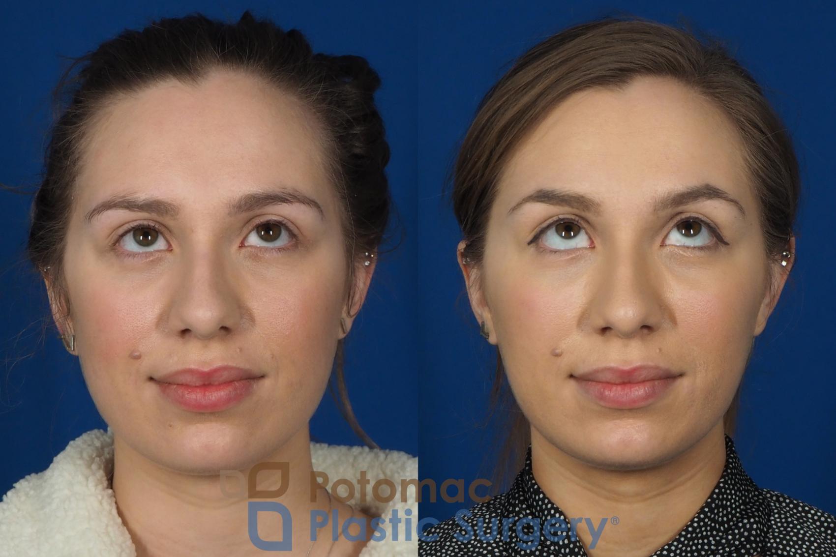 Before & After Dermal Fillers Case 242 Front View #3 View in Washington DC & Arlington , DC