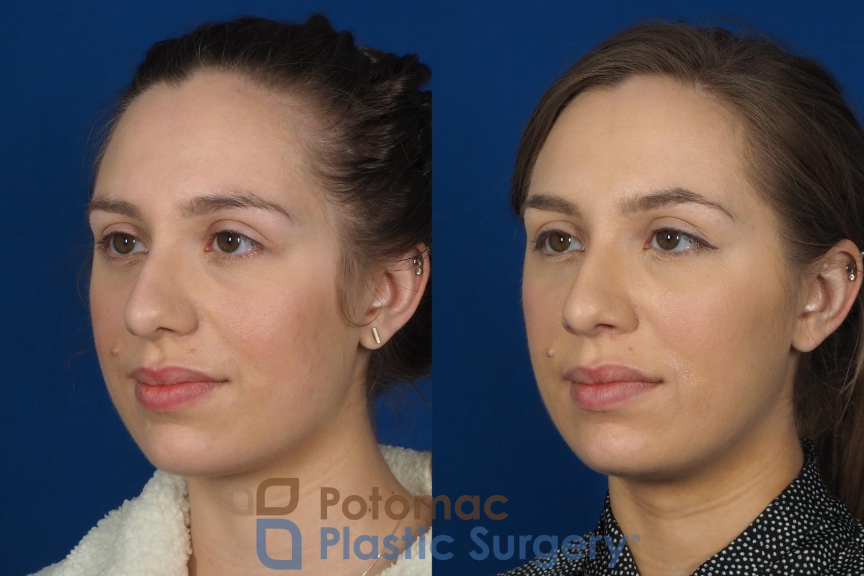 Before & After Dermal Fillers Case 242 Left Oblique View in Washington DC & Arlington , DC