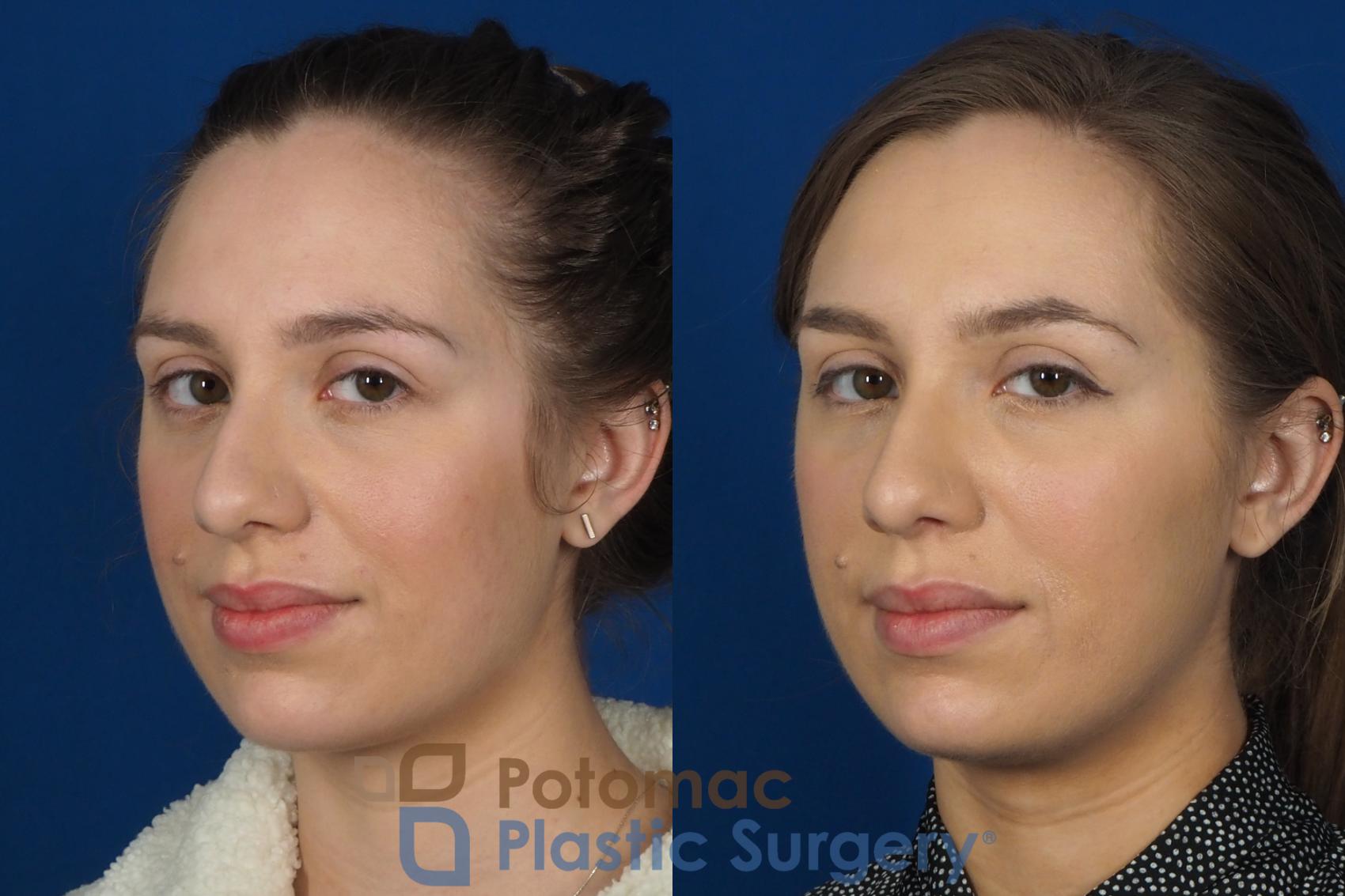 Before & After Dermal Fillers Case 242 Left Oblique View #2 View in Washington DC & Arlington , DC