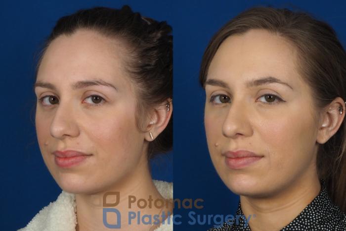 Before & After Botox Cosmetic Case 242 Left Oblique View #2 View in Washington DC & Arlington , DC