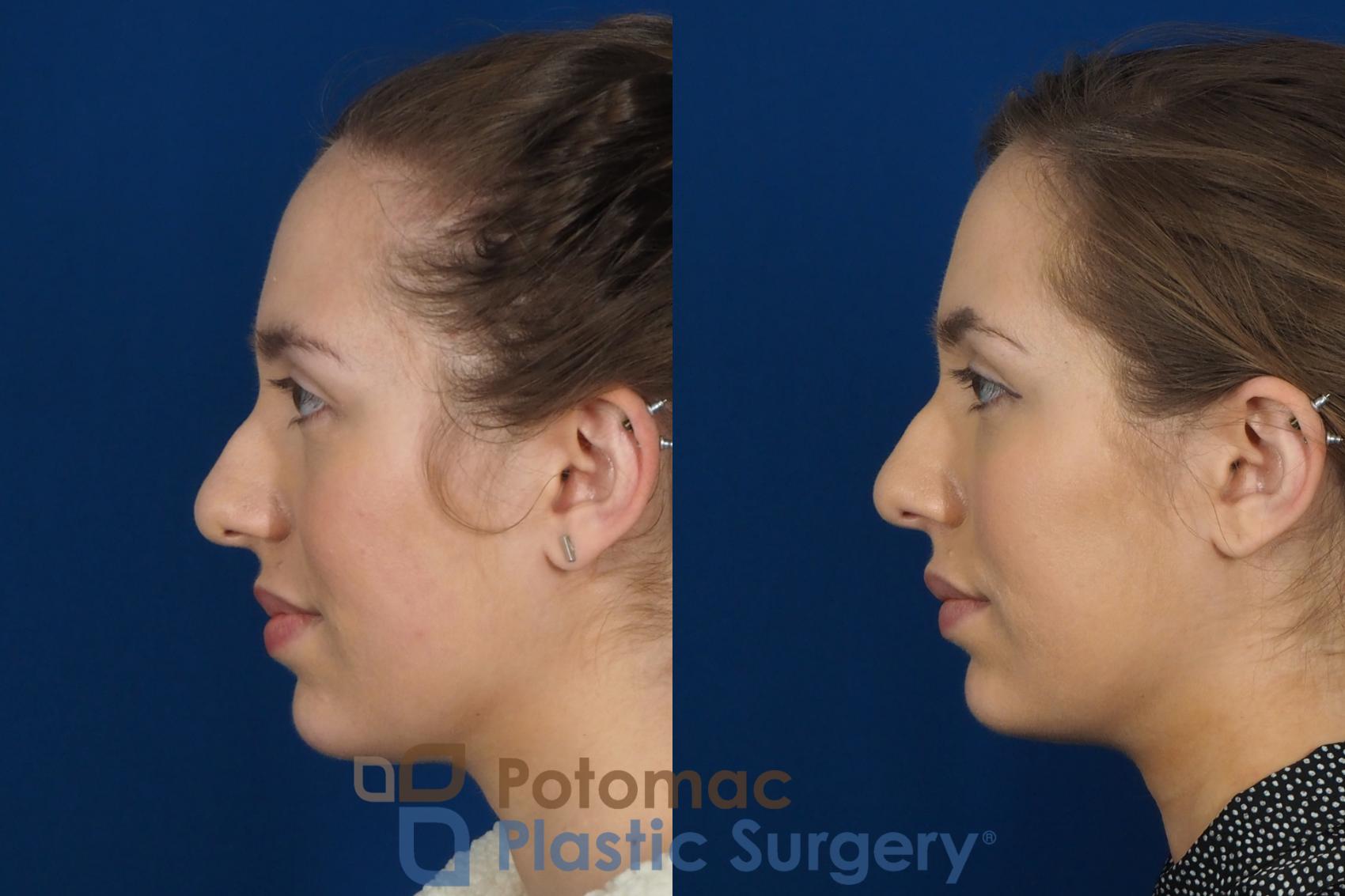 Before & After Dermal Fillers Case 242 Left Side View in Washington DC & Arlington , DC
