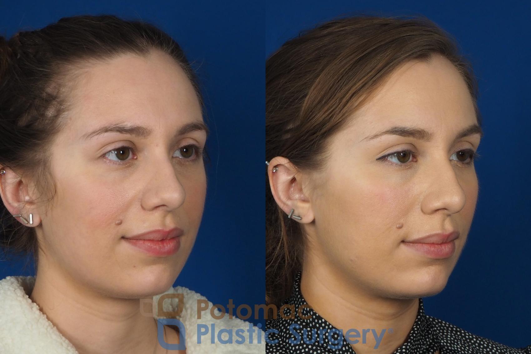 Before & After Dermal Fillers Case 242 Right Oblique View in Washington DC & Arlington , DC