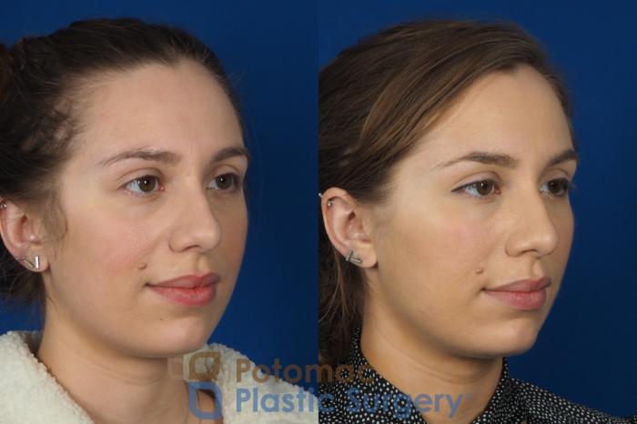 Before & After Liquid Facelift Case 242 Right Oblique View in Washington DC & Arlington , DC