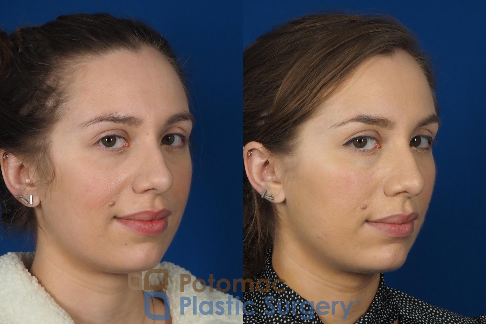 Before & After Dermal Fillers Case 242 Right Oblique View #2 View in Washington DC & Arlington , DC